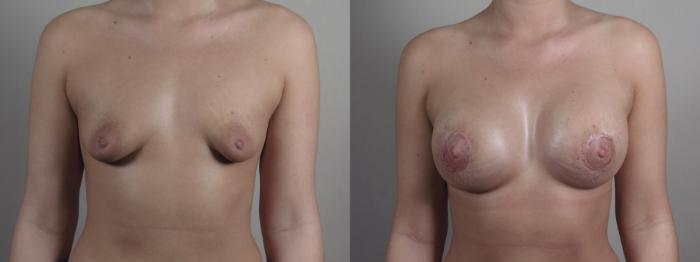 Correction of Tubular Breasts Case 972 Before & After Front | Paramus, New Jersey | Parker Center for Plastic Surgery
