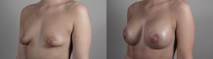 Correction of Tubular Breasts Case 972 Before & After Right Oblique | Paramus, New Jersey | Parker Center for Plastic Surgery