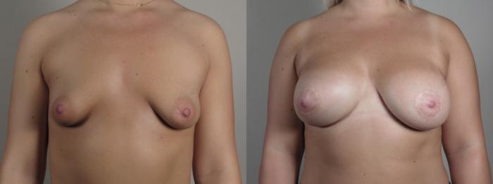Correction of Tubular Breasts Case 973 Before & After Front breast view | Paramus, New Jersey | Parker Center for Plastic Surgery
