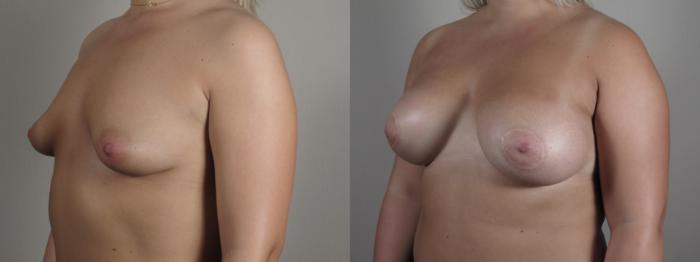 Correction of Tubular Breasts Case 973 Before & After right oblique breast  | Paramus, New Jersey | Parker Center for Plastic Surgery