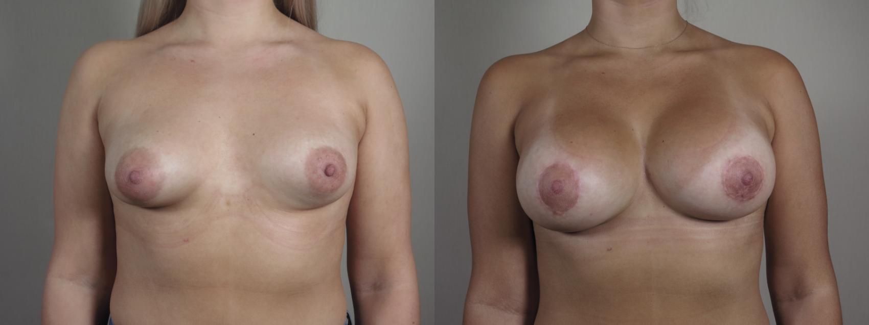 Correction of Tubular Breasts Case 974 Before & After front 2 | Paramus, New Jersey | Parker Center for Plastic Surgery