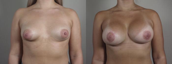 Correction of Tubular Breasts Case 974 Before & After front 2 | Paramus, New Jersey | Parker Center for Plastic Surgery