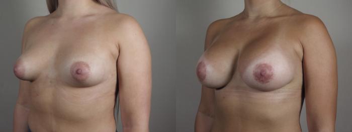 Correction of Tubular Breasts Case 974 Before & After right oblique 2 | Paramus, New Jersey | Parker Center for Plastic Surgery