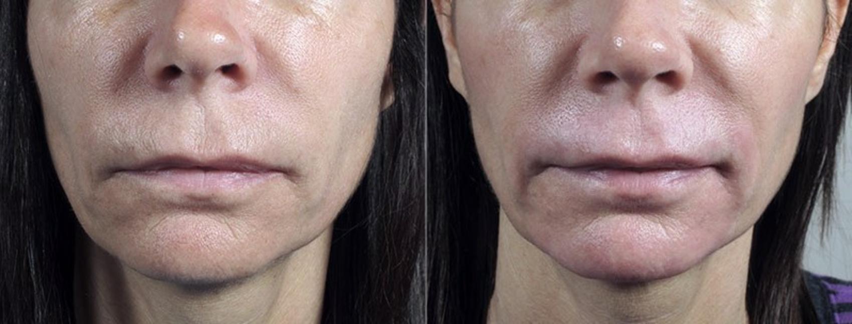 Dermabrasion Case 302 Before & After View #1 | Paramus, New Jersey | Parker Center for Plastic Surgery