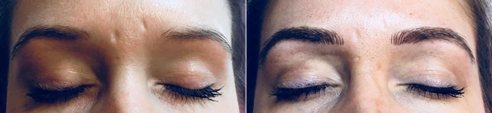 Dermabrasion Case 331 Before & After View #1 | Paramus, New Jersey | Parker Center for Plastic Surgery