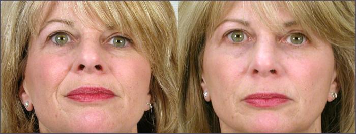 Dermal Fillers Case 269 Before & After View #1 | Paramus, New Jersey | Parker Center for Plastic Surgery