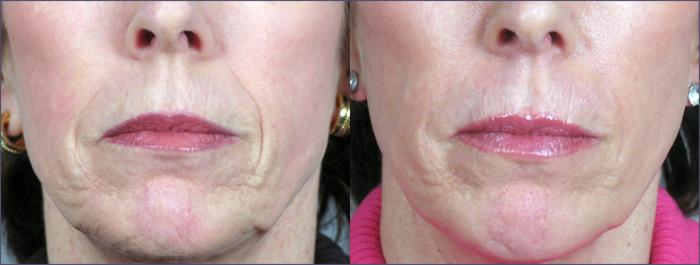 Dermal Fillers Case 272 Before & After View #1 | Paramus, New Jersey | Parker Center for Plastic Surgery