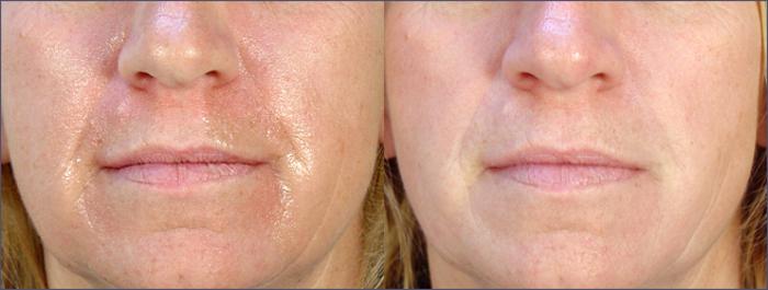 Dermal Fillers Case 273 Before & After View #1 | Paramus, New Jersey | Parker Center for Plastic Surgery