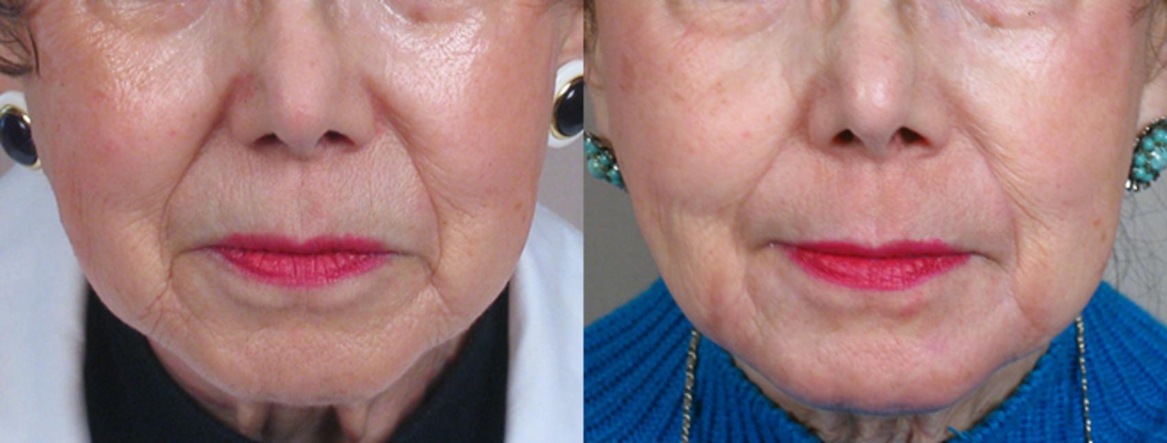 Dermal Fillers Case 276 Before & After View #1 | Paramus, New Jersey | Parker Center for Plastic Surgery