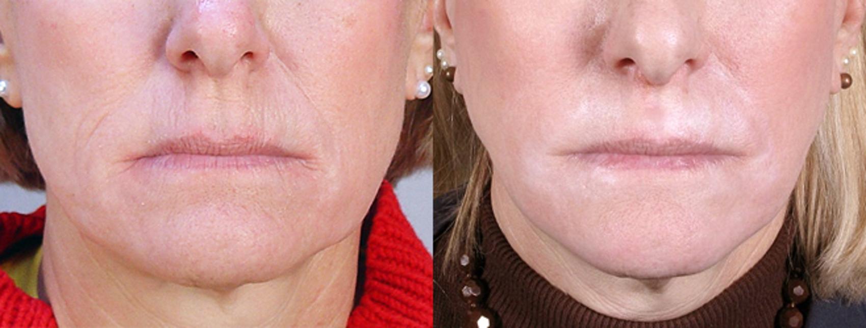 Dermal Fillers Case 277 Before & After View #1 | Paramus, New Jersey | Parker Center for Plastic Surgery