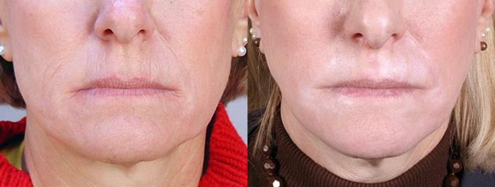 Dermal Fillers Case 277 Before & After View #1 | Paramus, New Jersey | Parker Center for Plastic Surgery