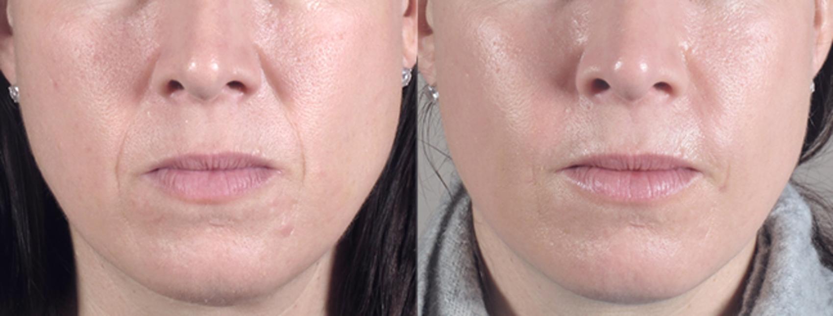 Dermal Fillers Case 278 Before & After View #1 | Paramus, New Jersey | Parker Center for Plastic Surgery