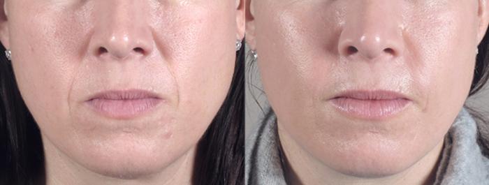 Dermal Fillers Case 278 Before & After View #1 | Paramus, New Jersey | Parker Center for Plastic Surgery