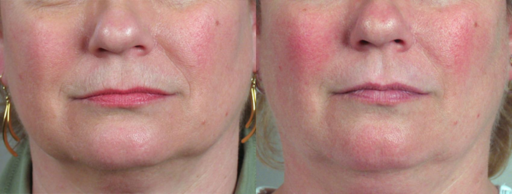 Dermal Fillers Case 279 Before & After View #1 | Paramus, New Jersey | Parker Center for Plastic Surgery