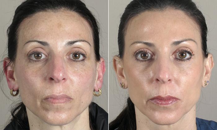 Dermal Fillers Case 280 Before & After View #1 | Paramus, New Jersey | Parker Center for Plastic Surgery