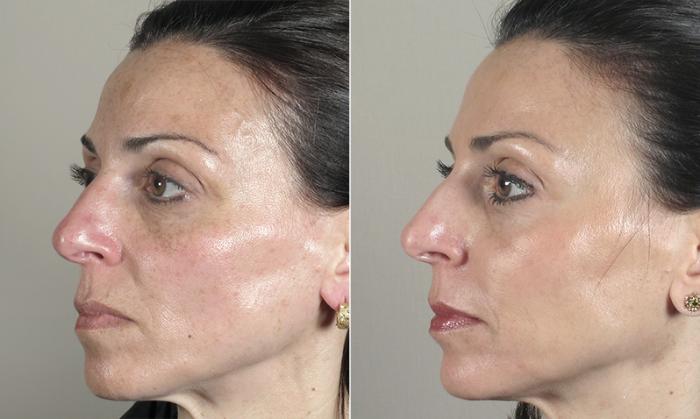 Dermal Fillers Case 280 Before & After View #2 | Paramus, New Jersey | Parker Center for Plastic Surgery