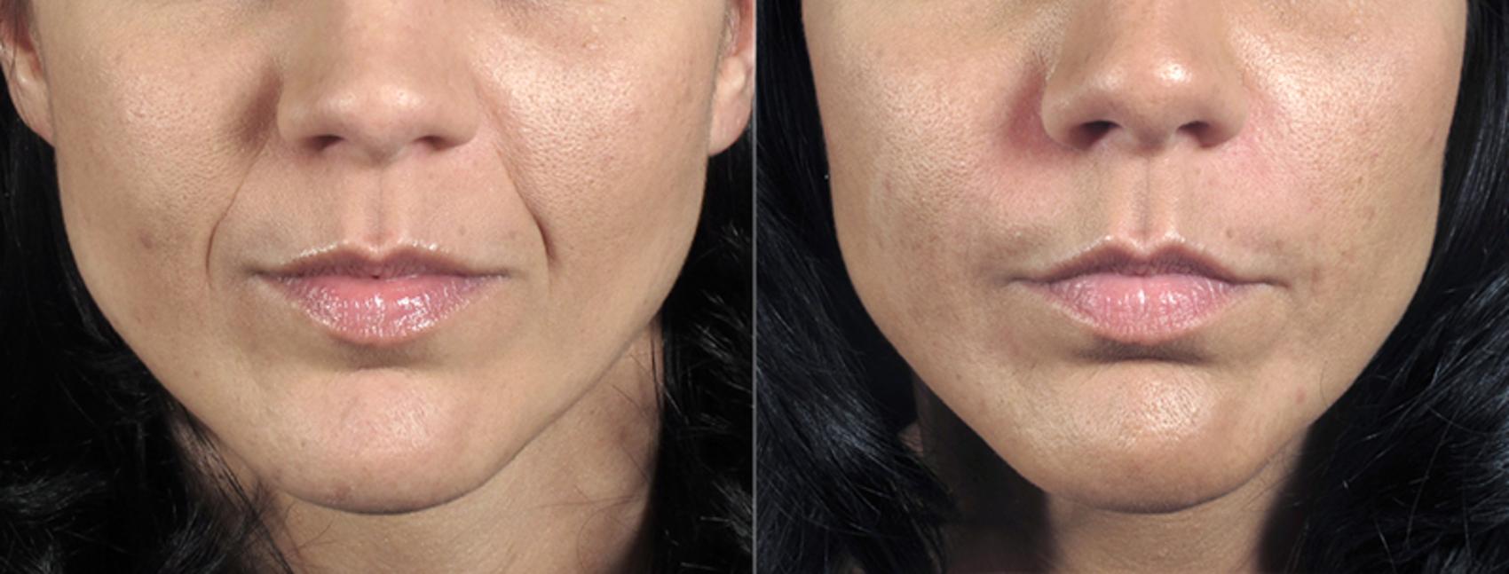 Dermal Fillers Case 283 Before & After View #1 | Paramus, New Jersey | Parker Center for Plastic Surgery