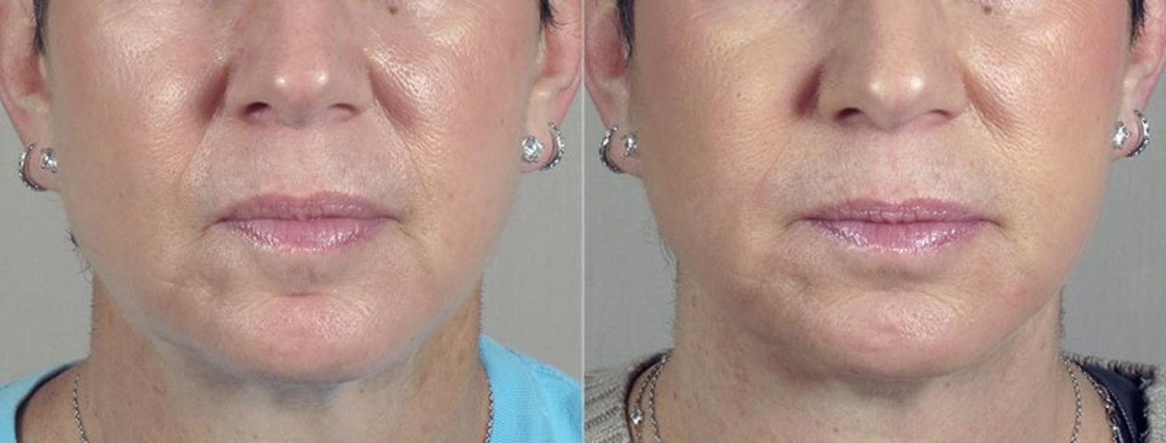 Dermal Fillers Case 284 Before & After View #1 | Paramus, New Jersey | Parker Center for Plastic Surgery