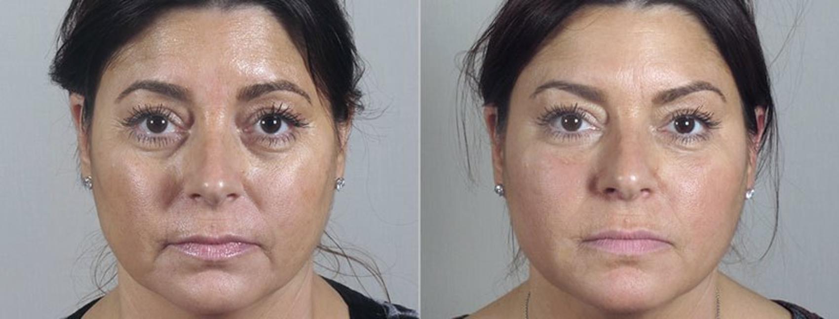 Dermal Fillers Case 286 Before & After View #1 | Paramus, New Jersey | Parker Center for Plastic Surgery