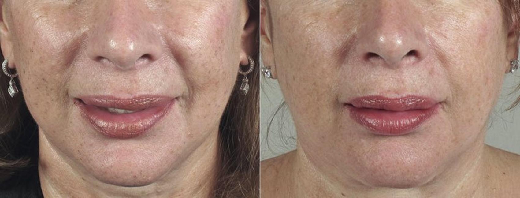 Dermal Fillers Case 291 Before & After View #1 | Paramus, New Jersey | Parker Center for Plastic Surgery