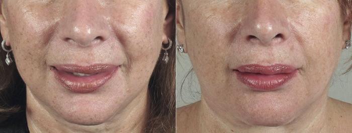 Dermal Fillers Case 291 Before & After View #1 | Paramus, New Jersey | Parker Center for Plastic Surgery