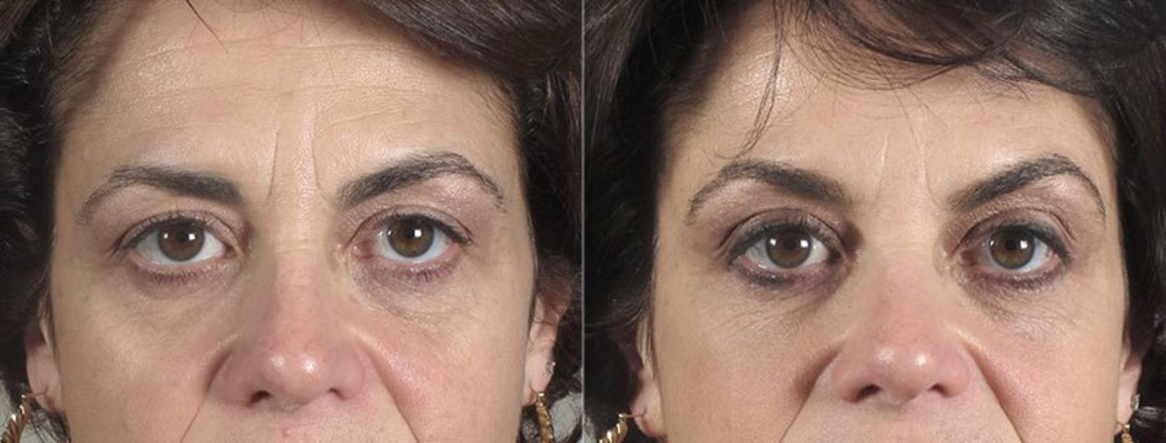 Nonsurgical Face Procedures Case 292 Before & After View #1 | Paramus, New Jersey | Parker Center for Plastic Surgery
