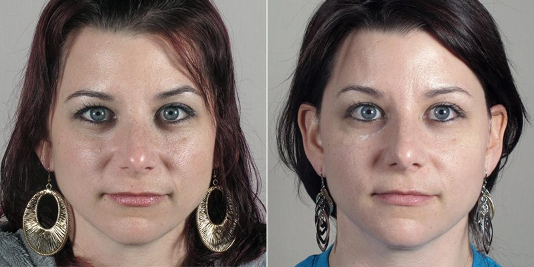 Dermal Fillers Case 295 Before & After View #1 | Paramus, New Jersey | Parker Center for Plastic Surgery