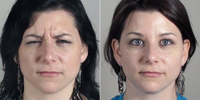 Dermal Fillers Case 295 Before & After View #2 | Paramus, New Jersey | Parker Center for Plastic Surgery