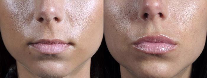 Lip Injections Case 301 Before & After View #1 | Paramus, New Jersey | Parker Center for Plastic Surgery