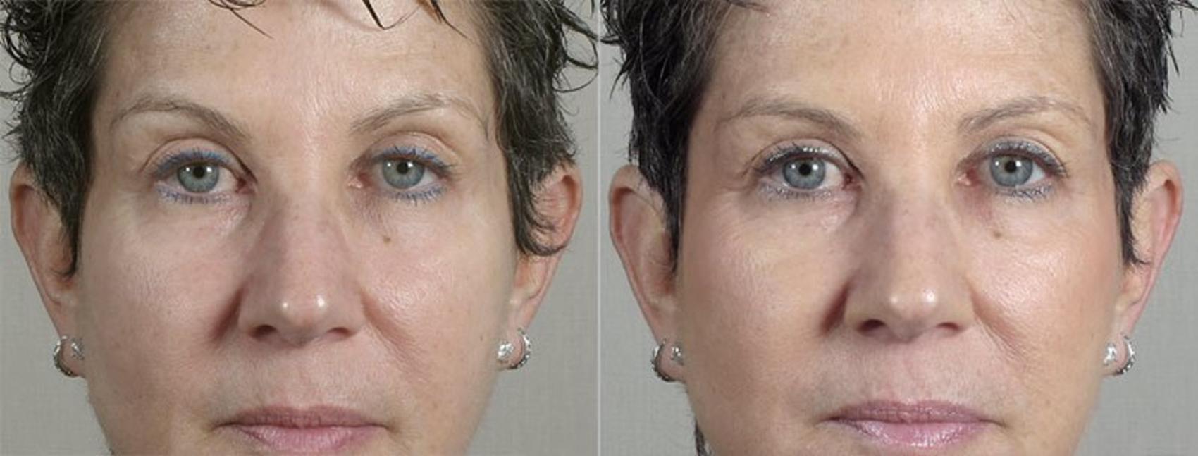 Dermal Fillers Case 307 Before & After View #1 | Paramus, New Jersey | Parker Center for Plastic Surgery
