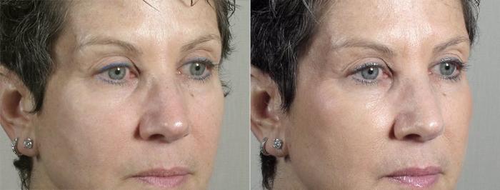Dermal Fillers Case 307 Before & After View #2 | Paramus, New Jersey | Parker Center for Plastic Surgery