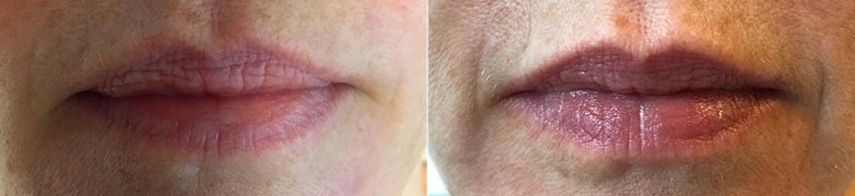 Dermal Fillers Case 334 Before & After View #1 | Paramus, New Jersey | Parker Center for Plastic Surgery