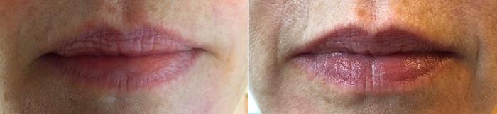Dermal Fillers Case 334 Before & After View #1 | Paramus, New Jersey | Parker Center for Plastic Surgery