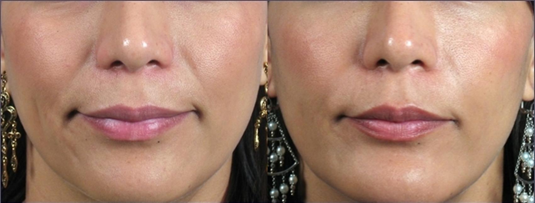Dermal Fillers Case 956 Before & After View #5 | Paramus, New Jersey | Parker Center for Plastic Surgery
