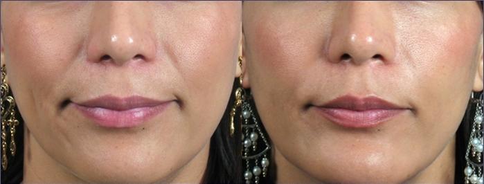 Dermal Fillers Case 956 Before & After View #5 | Paramus, New Jersey | Parker Center for Plastic Surgery