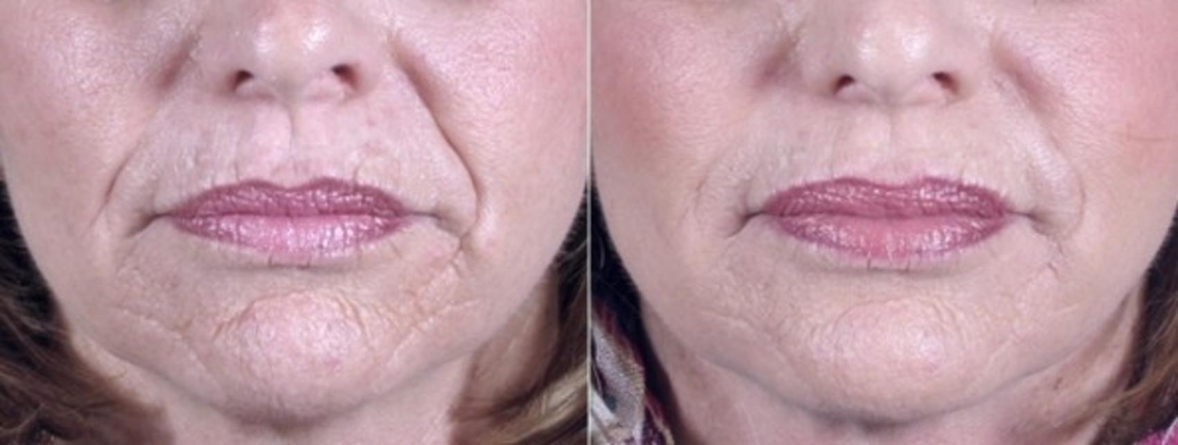 Dermal Fillers Case 957 Before & After View #5 | Paramus, New Jersey | Parker Center for Plastic Surgery
