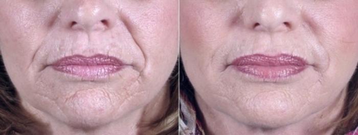 Dermal Fillers Case 957 Before & After View #5 | Paramus, New Jersey | Parker Center for Plastic Surgery