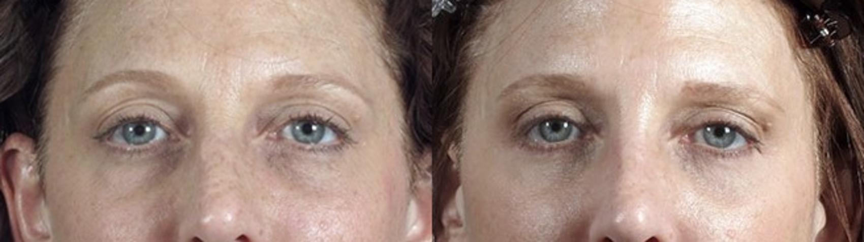 Eyelid Lift Case 100 Before & After View #1 | Paramus, New Jersey | Parker Center for Plastic Surgery