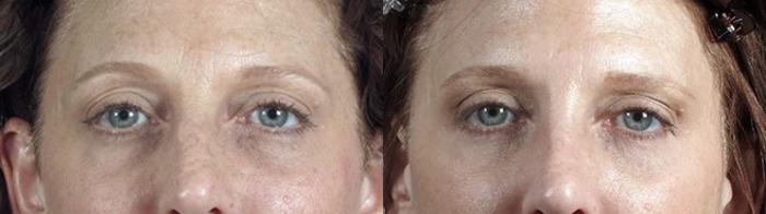 Eyelid Lift Case 100 Before & After View #1 | Paramus, New Jersey | Parker Center for Plastic Surgery