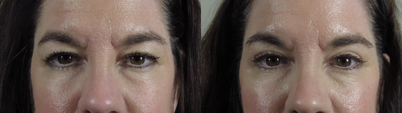 Eyelid Lift Case 1004 Before & After Front | Paramus, New Jersey | Parker Center for Plastic Surgery