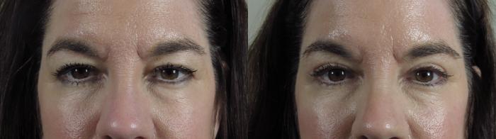 Eyelid Lift Case 1004 Before & After Front | Paramus, New Jersey | Parker Center for Plastic Surgery