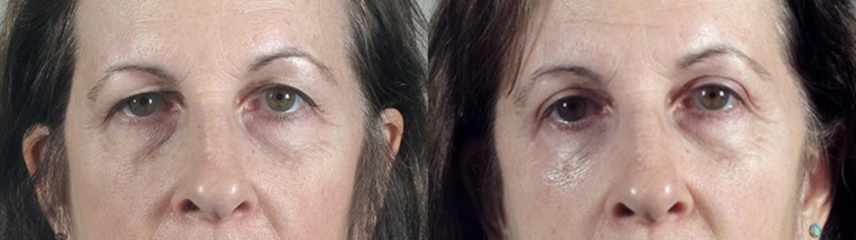 Eyelid Lift Case 101 Before & After View #1 | Paramus, New Jersey | Parker Center for Plastic Surgery