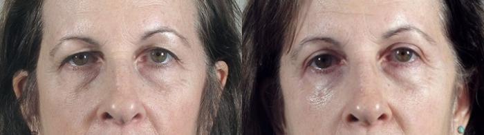 Eyelid Lift Case 101 Before & After View #1 | Paramus, New Jersey | Parker Center for Plastic Surgery