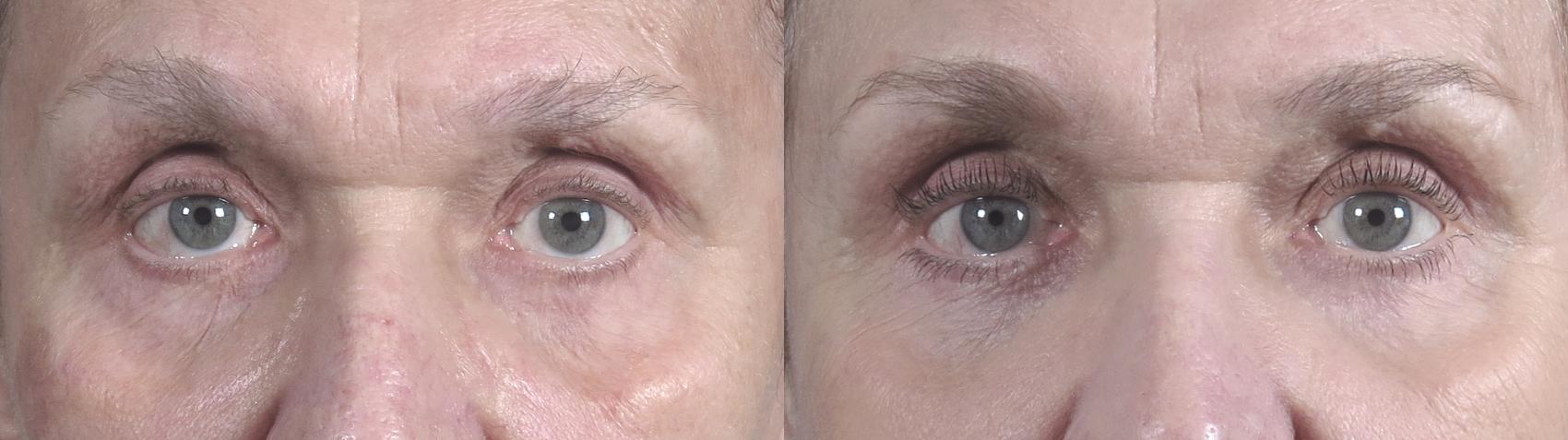 Eyelid Lift Case 1016 Before & After Front | Paramus, New Jersey | Parker Center for Plastic Surgery