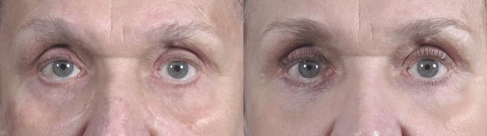 Eyelid Lift Case 1016 Before & After Front | Paramus, New Jersey | Parker Center for Plastic Surgery