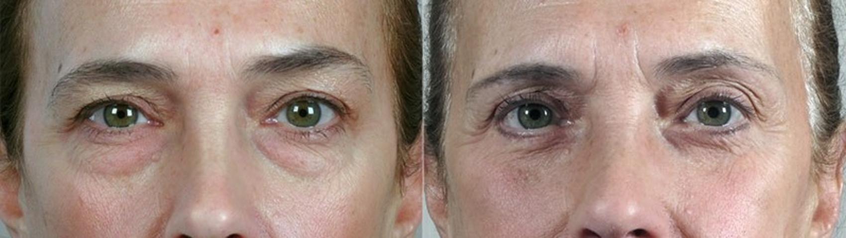 Eyelid Lift Case 102 Before & After View #1 | Paramus, New Jersey | Parker Center for Plastic Surgery