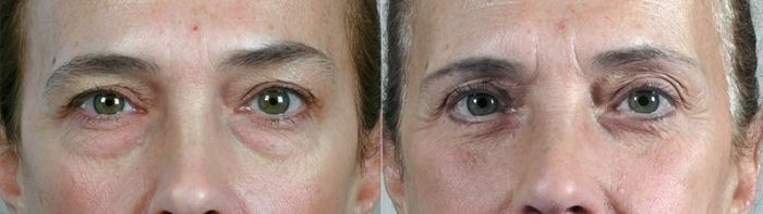 Eyelid Lift Case 102 Before & After View #1 | Paramus, New Jersey | Parker Center for Plastic Surgery
