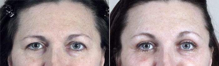 Eyelid Lift Case 103 Before & After View #2 | Paramus, New Jersey | Parker Center for Plastic Surgery
