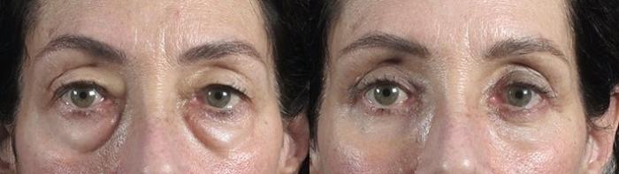 Eyelid Lift Case 104 Before & After View #1 | Paramus, New Jersey | Parker Center for Plastic Surgery