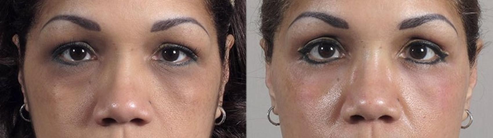 Eyelid Lift Case 105 Before & After View #1 | Paramus, New Jersey | Parker Center for Plastic Surgery